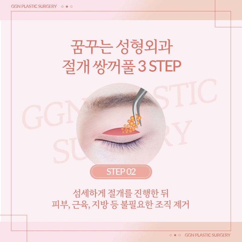 [강남 쌍꺼풀 수술]쌍꺼풀 절개법이란? 사진 4