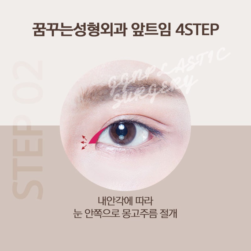 [강남 눈성형] 트임성형은 어떻게 진행될까요? 사진 5