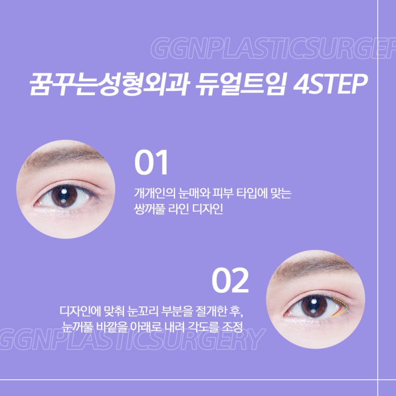 [강남 눈성형] 듀얼 트임을 아시나요? 사진 5