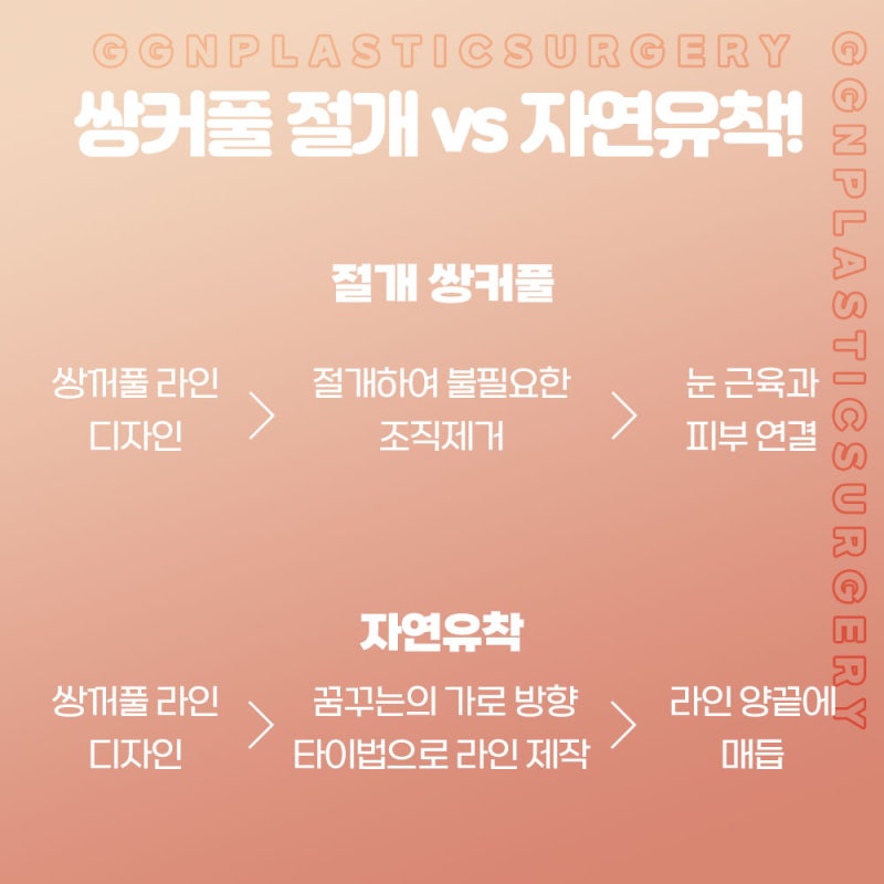 [강남 눈성형]쌍커풀과 눈매교정 어떤걸 해야할까? 사진 4
