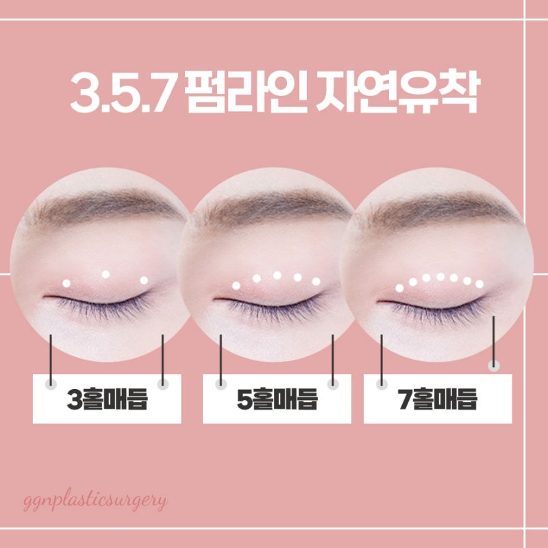 [강남 눈성형] 풀리지 않는 자연스러운 쌍꺼풀라인, 자연유착펌라인