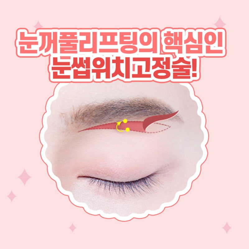 [강남 눈성형] 어리고 환한 눈매로 만들어주는 눈꺼풀 리프팅!