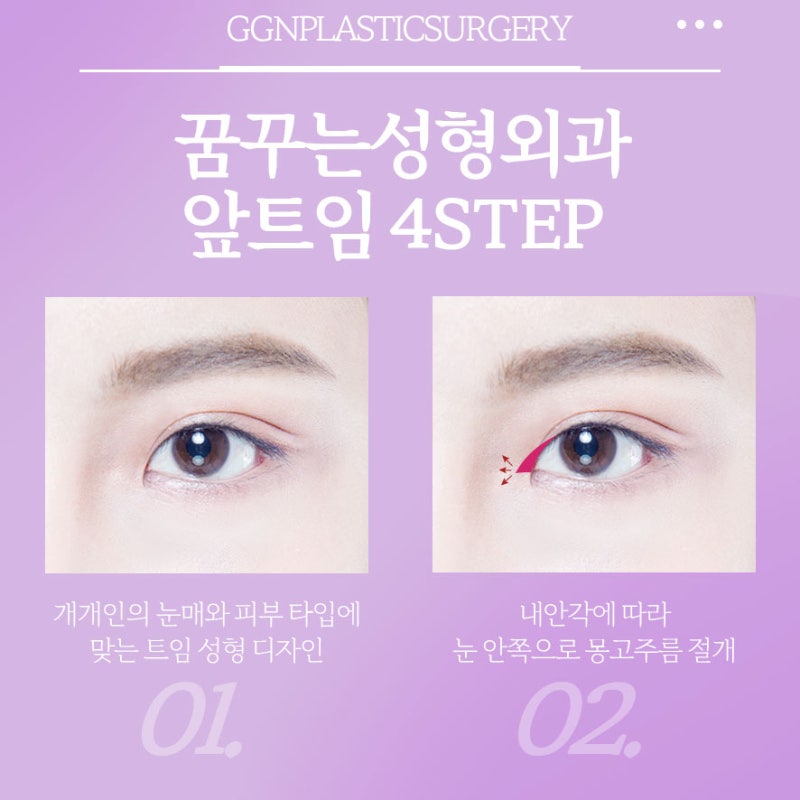 [강남 눈성형] 크고 시원한 눈매를 만들어주는 앞트임! 사진 4