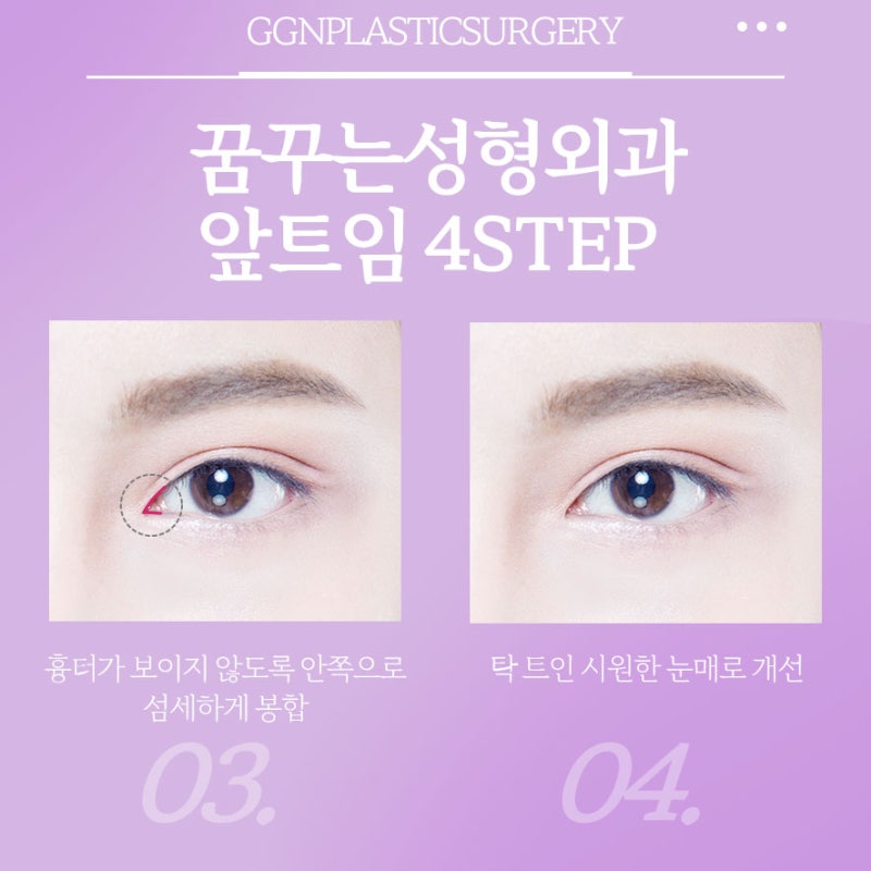 [강남 눈성형] 꿈꾸는 성형외과의 수험생을 위한 앞트임 EVENT!!!!(11월 18일~12월 17일) 사진 5