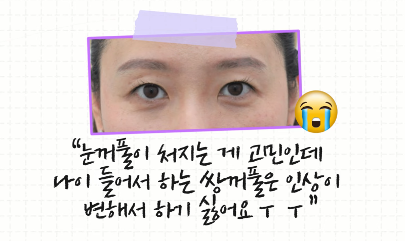 내 눈에 딱 맞는 쌍꺼풀 수술법은? 사진 3
