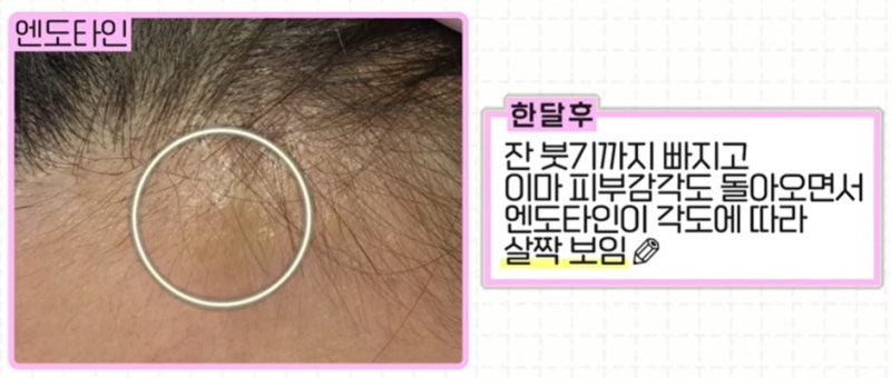 [강남 꿈꾸는 성형외과] 나에게 맞는 이마 거상 수술 방법 찾기!(엔도타인 vs 본터널링) 사진 14