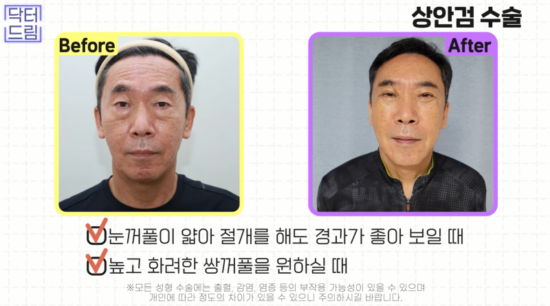 [강남 꿈꾸는 성형외과] 동안 되는 중년 성형 TOP3!! 사진 7