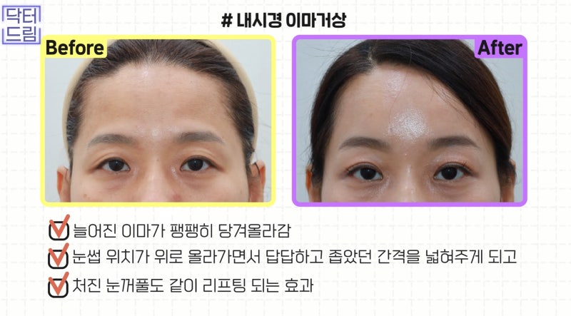 [강남 꿈꾸는 성형외과] 내 눈에 딱 맞는 눈 수술(자가진단법!) 사진 5