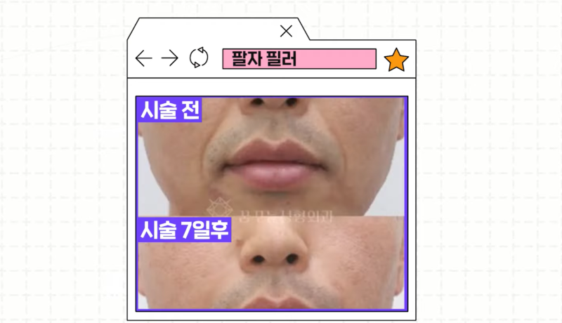 [강남 꿈꾸는성형외과] 족집게 과외 / 나에게 맞는 안티에이징 찾아드림!! 사진 24