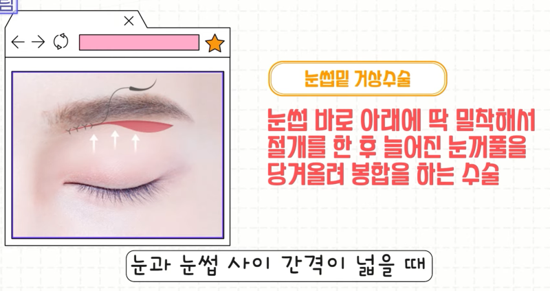 [강남 꿈꾸는성형외과] 족집게 과외 / 나에게 맞는 안티에이징 찾아드림!! 사진 12