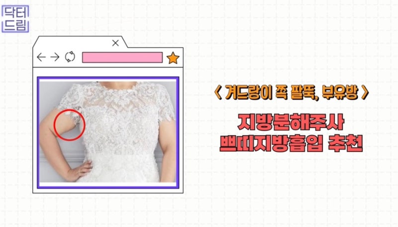 [강남 꿈꾸는 성형외과] 웨딩시즌! 결혼 전 준비해야 할 성형 꿀팁 2탄(3개월 ~ 본식 당일) 사진 8