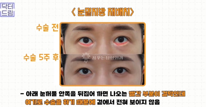 [강남 꿈꾸는성형외과] 성형 후 흉터 걱정 NO! 티 안 나게 젊고 예뻐지는 3가지 꿀팁! 사진 16