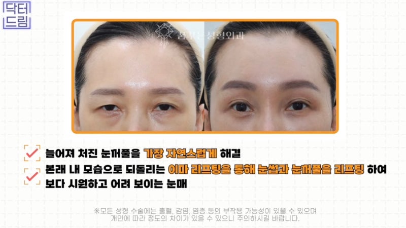 [강남 꿈꾸는성형외과] 성형 후 흉터 걱정 NO! 티 안 나게 젊고 예뻐지는 3가지 꿀팁!