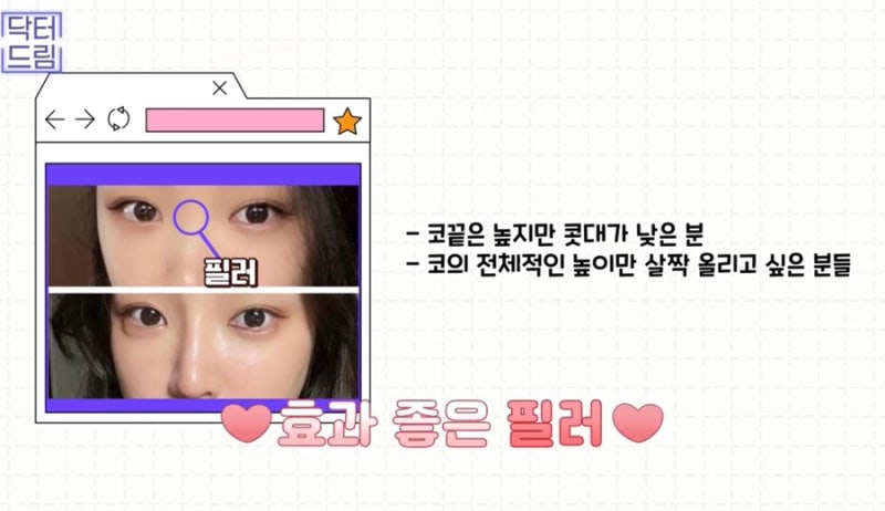 [강남 꿈꾸는 성형외과] 동안 비법 ㅣ 지방이식 vs 필러 시술 사진 13