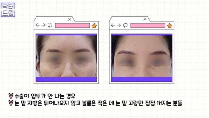 [강남 꿈꾸는 성형외과] 동안 비법 ㅣ 지방이식 vs 필러 시술 사진 12