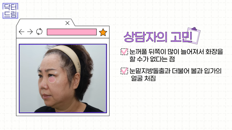 [강남꿈꾸는성형외과] 드림쌤 '중년 여성 성형' 상담 노트! 사진 11