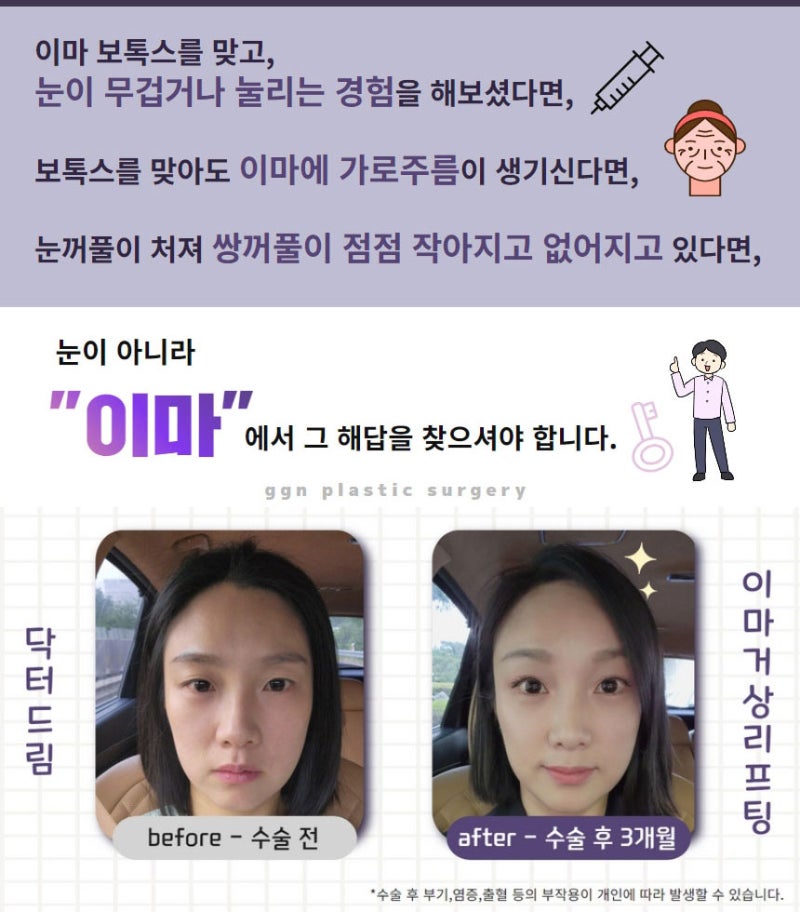 내시경이마거상 확실한 동안 비법 사진 4