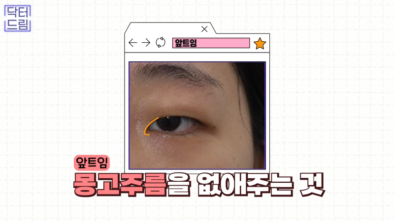 [강남꿈꾸는성형외과] 눈! 트임에 관한 모든 것!! 사진 13