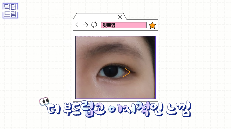 [강남꿈꾸는성형외과] 눈! 트임에 관한 모든 것!! 사진 21