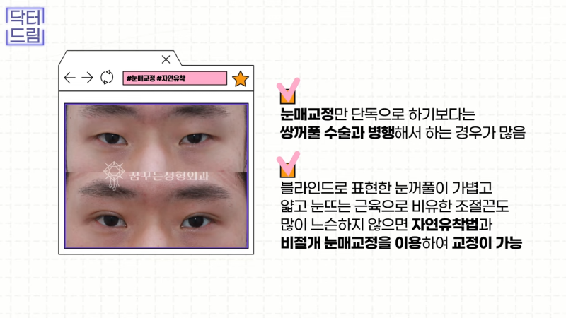 [강남 꿈꾸는 성형외과] 눈매교정에 대한 모든 것! 사진 17