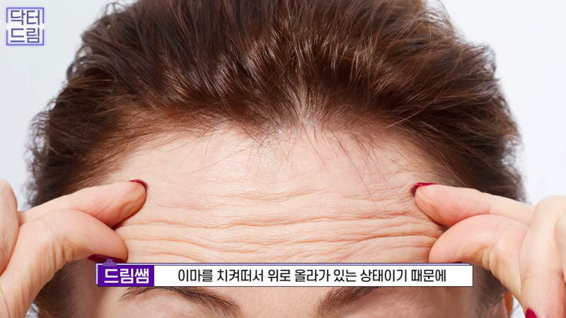 [강남 꿈꾸는 성형외과] 내시경 이마 리프팅 제대로 효과 보는 법 사진 12