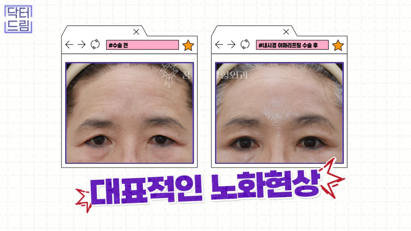 [강남 꿈꾸는 성형외과] 내시경 이마 리프팅 제대로 효과 보는 법 사진 10