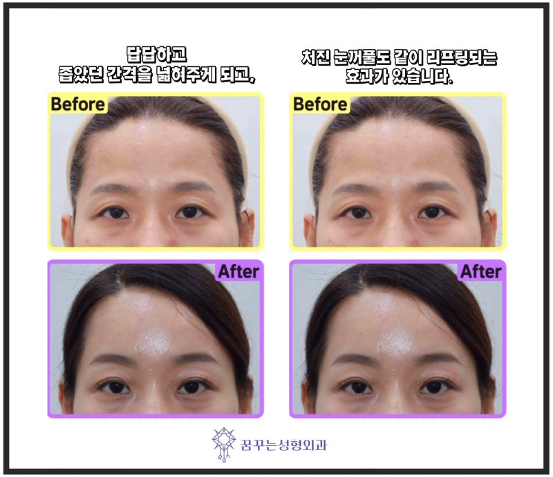이마리프팅/이마거상-쌍꺼풀을 하면 안되는 유형은?[꿈꾸는성형외과] 사진 3