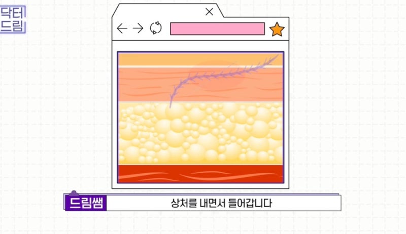 [강남꿈꾸는성형외과] 찰떡궁합! 함께하면 좋은 성형수술 사진 17