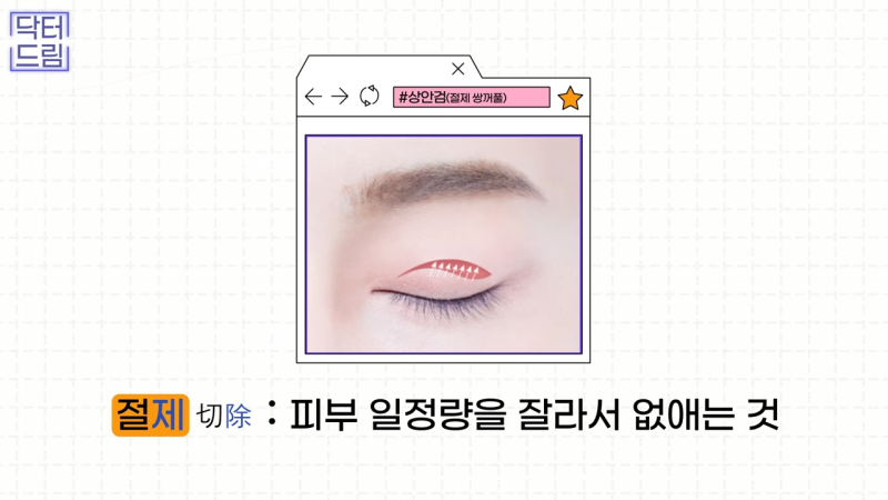 [강남꿈꾸는성형외과] 쌍수? 상안검? 내게 딱 맞는 눈 수술법 바로 알기! 사진 5