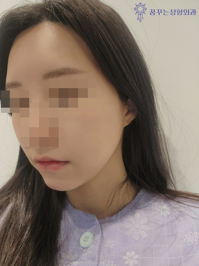 강남 피부관리 티타늄 리프팅 어떤가요?