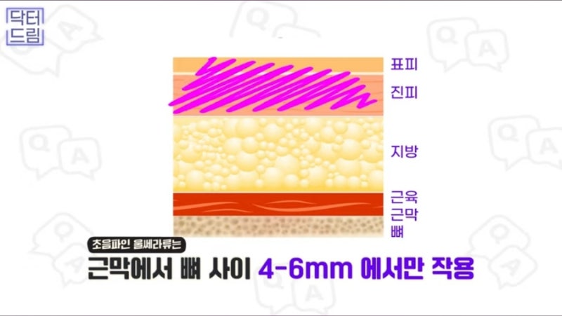 2023결산_ 가장 인기많은 핫한 레이저는? 사진 10