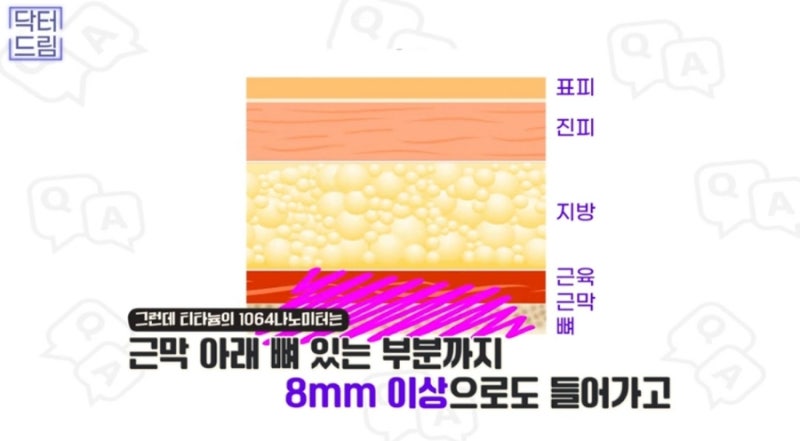 2023결산_ 가장 인기많은 핫한 레이저는? 사진 11