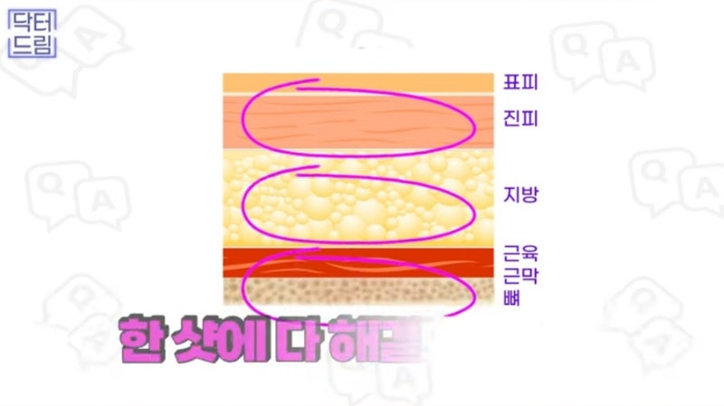 2023결산_ 가장 인기많은 핫한 레이저는? 사진 12