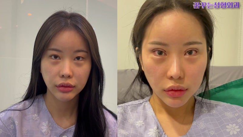 쌍꺼풀수술을 하는데에 고려할 사항 [꿈꾸는성형외과] 사진 7