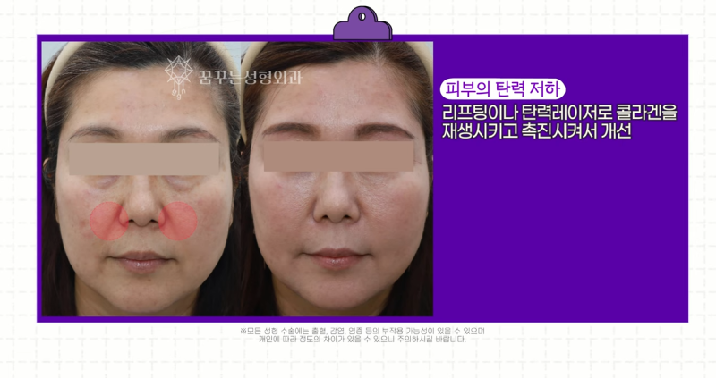 팔자주름 마리오네트주름 입가주름 해결법 사진 7