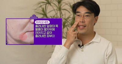 팔자주름 마리오네트주름 입가주름 해결법 사진 11