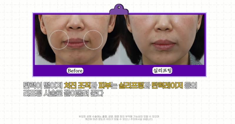 팔자주름 마리오네트주름 입가주름 해결법 사진 13