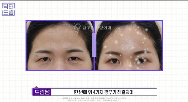 힙한 mz는 다 알고있는 이마리프팅 사진 10