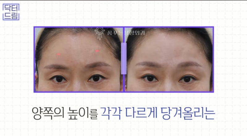 힙한 mz는 다 알고있는 이마리프팅 사진 18