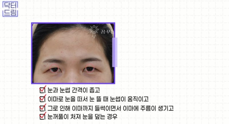 힙한 mz는 다 알고있는 이마리프팅 사진 9