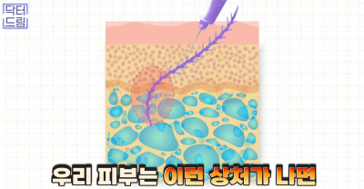 실리프팅 해 본 사람만 알 수 있는 비밀 사진 20