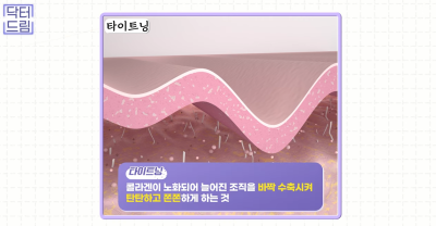 실리프팅 해 본 사람만 알 수 있는 비밀 사진 7