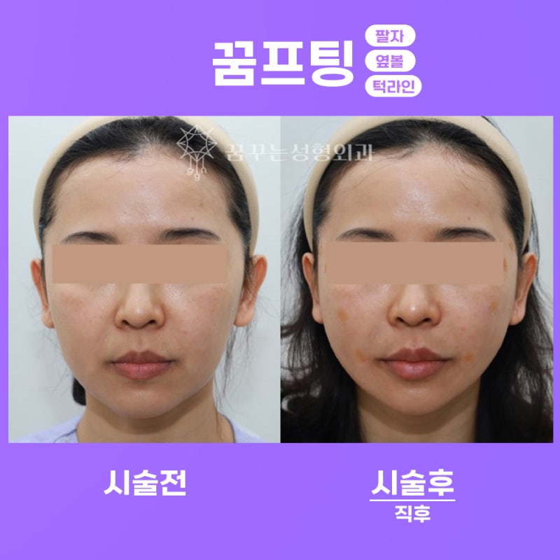 실리프팅, 그 효과와 매력- 강남 페이스 리프팅 꿈꾸는성형외과 사진 4