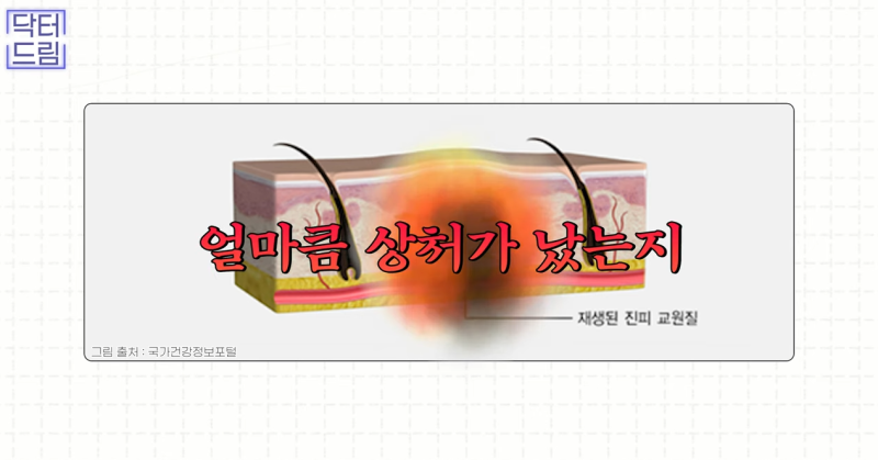 [강남역 성형외과] 켈로이드라서 쌍꺼풀 수술 고민하고 있다면 보세요. 흉터에 관한 모든걸 알려드려요 사진 3