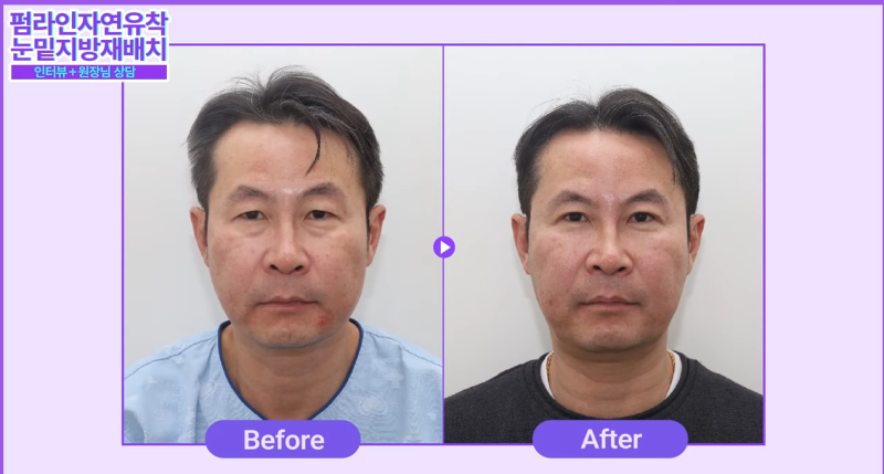 50대 중년 남자 노화고민 / 안티에이징 수술 솔직후기 사진 10