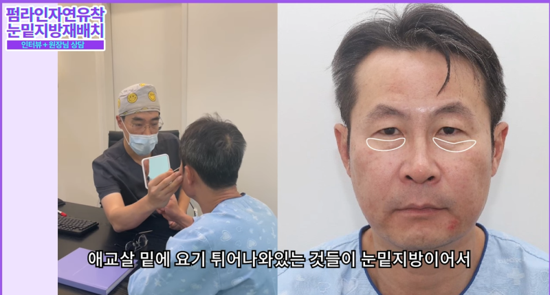 50대 중년 남자 노화고민 / 안티에이징 수술 솔직후기 사진 9
