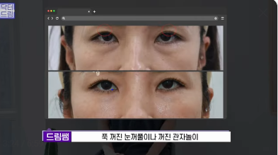 [강남역 성형외과] 이거 모르면 보톡스, 필러 맞았다가 후회합니다 사진 33