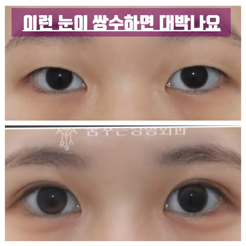 쌍꺼풀하면 대박나는 4가지 유형 사진 2