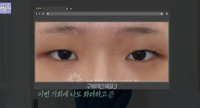 [강남역성형외과] 성형외과 처음갈 때 망하고 싶지 않으면 보세요 (상담꿀팁, 병원선택기준) 사진 26
