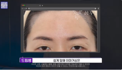 [강남역 성형외과] 깊어져만 가는 이마주름이 고민이라면 이것을 하세요 사진 25